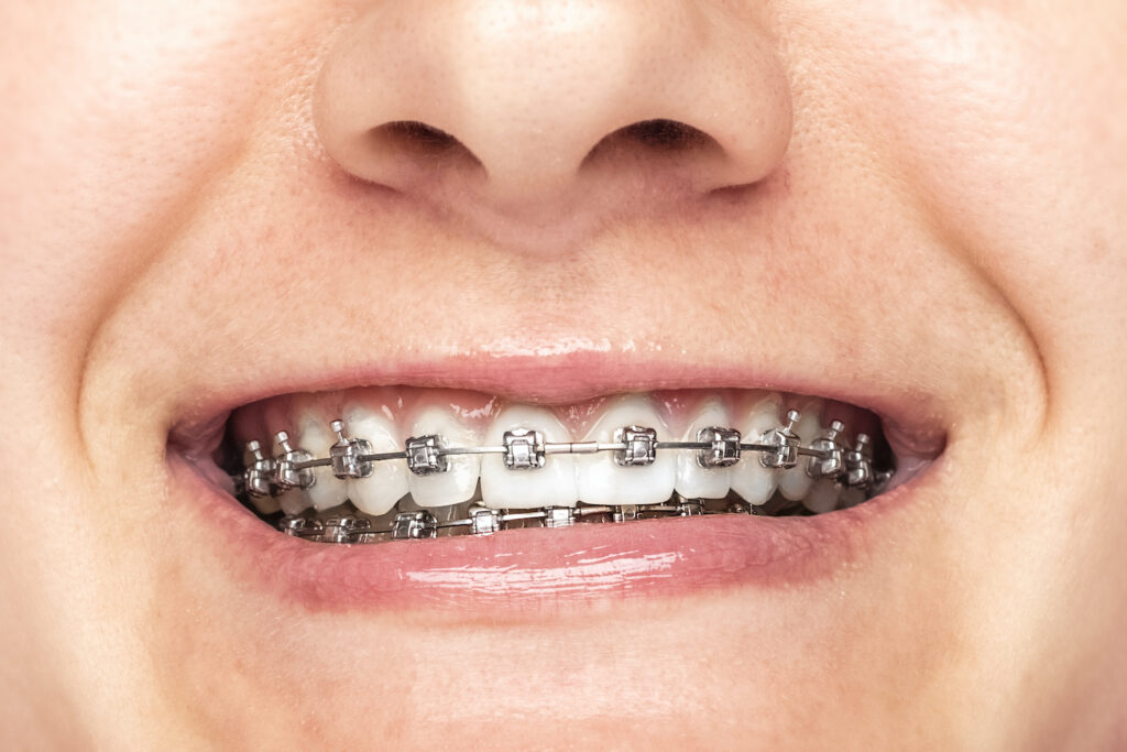 Braces in Waco TX can often move your teeth with a gentle pressure.