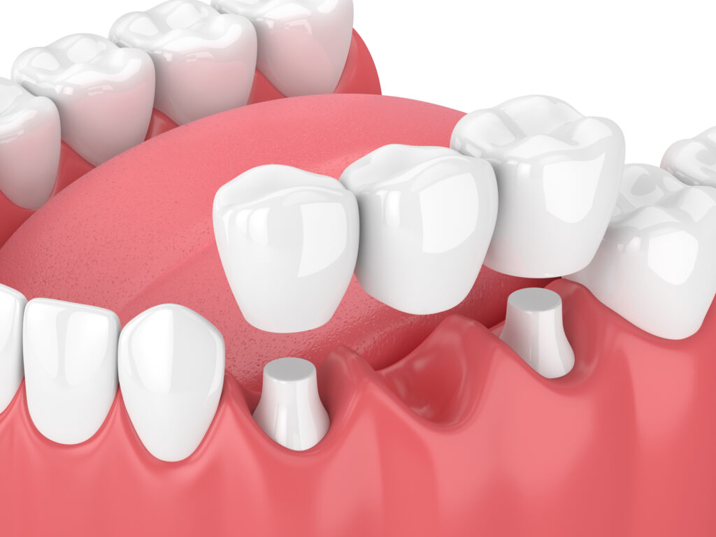 dental bridge in Waco, TX