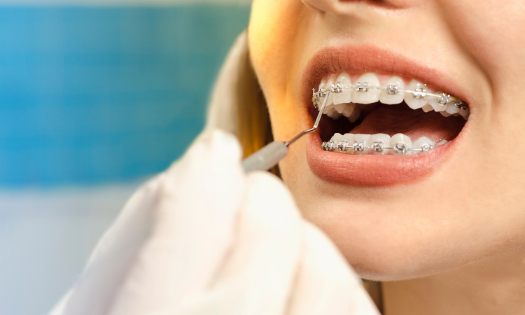 Understanding the benefits and mechanisms of traditional braces can help you make an informed decision about your orthodontic treatment.